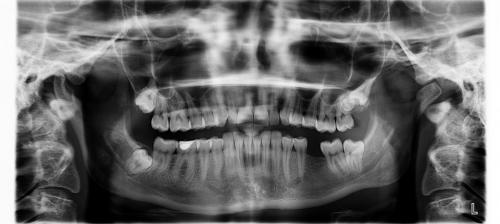 Mit láthat a fogorvos a panoráma röntgenen?